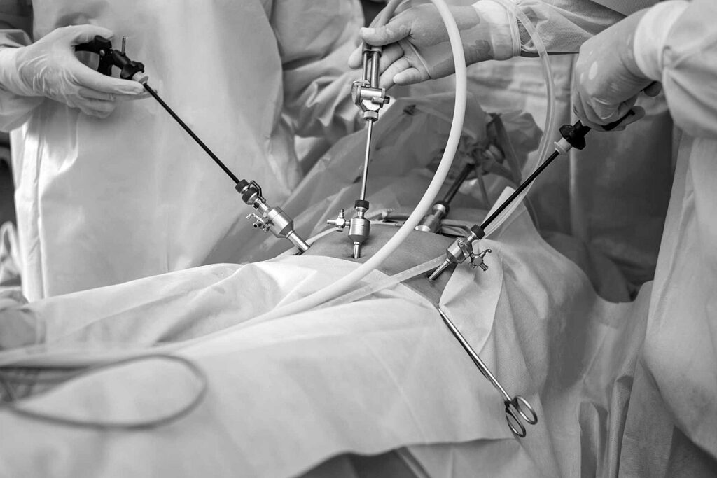 Primera gastrectomía total por laparoscopía en Paysandú
