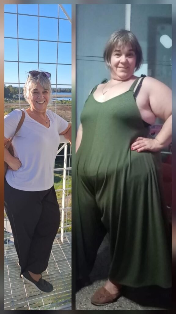 Inés y su experiencia con la cirugía bariátrica en CLIBA: un testimonio real de transformación, salud y esperanza