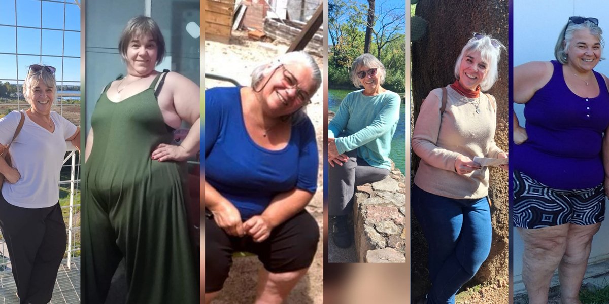 Inés y su experiencia con la cirugía bariátrica en CLIBA: un testimonio real de transformación, salud y esperanza